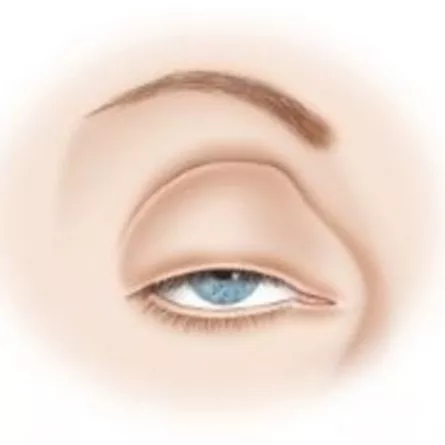 Close up of eye demonstrating droopy eyelid