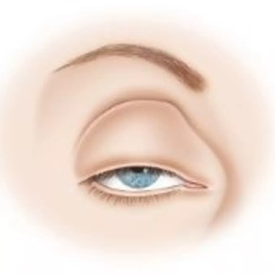 Droopy Eyelid (Ptosis) How to Fix Droopy Eyelids Optegra