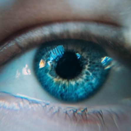 Close up of eye demonstrating glaucoma