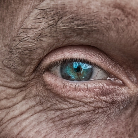 old age cataract