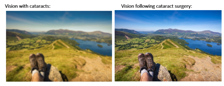 Comparison photo showing the difference between vision before and after cataracts surgery. The picture is of a view from the top of a hill.