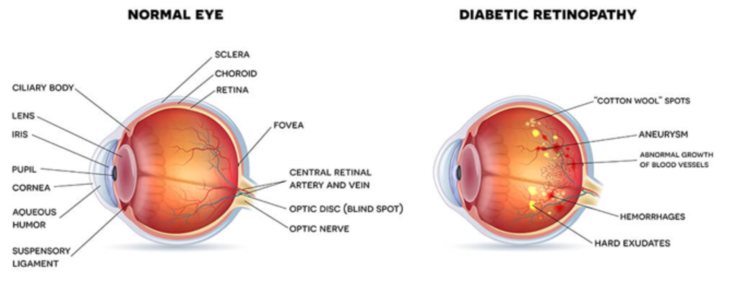 Diagram of the eye showing the difference between a normal eye and an eye with diabetic retinopathy