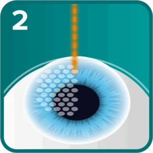 Step 2: A flap is created in the cornea using a femtosecond laser