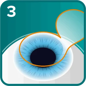 Step 3: The flap is moved to the side to expose the corneal bed