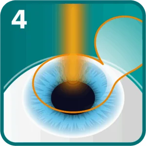 Step 4: Within seconds the cornea is reshaped by an excimer laser