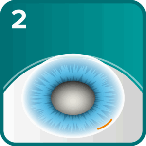 Cataract step 2 - small incision made at the base of the cornea for surgical access