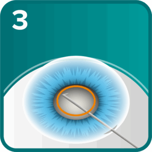Cataract step 3 - the front of the lens capsule is removed