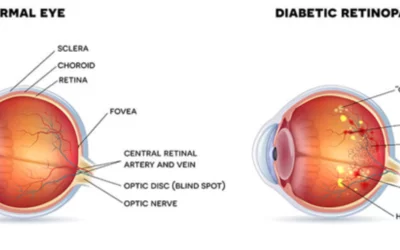 Diagram of the eye showing the difference between a normal eye and an eye with diabetic retinopathy