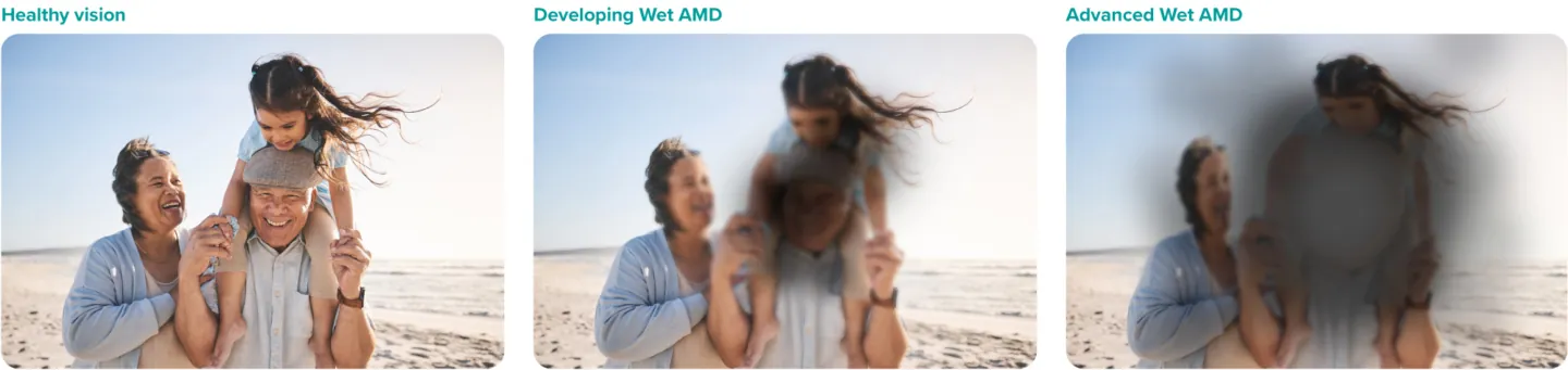 Image showing stages of vision degeneration with wet AMD, from healthy clear vision, to a slight dark blurry spot in the central vision with developing wet AMD, to a large dark blurry spot in the central vision with advanced wet AMD