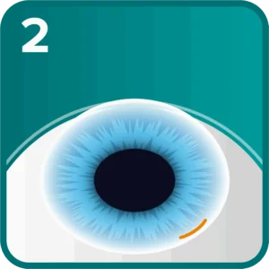 ICL step 2 - Small incision made at the base of the cornea for surgical access