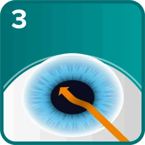 ICL step 3 - the ICL is inserted behind the iris, in front of the natural lens
