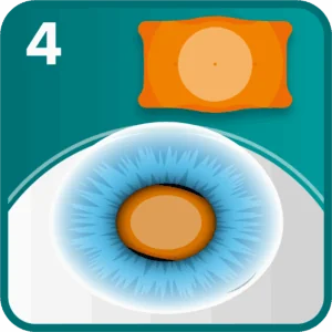 ICL step 4 - the ICL sits in front of the natural lens