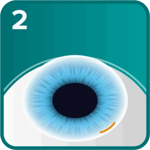 RLE step 2 - small incision made at the base of the cornea for surgical access
