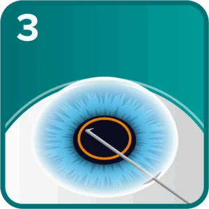 RLE step 3 - the front of the lens capsule is removed