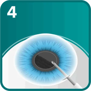 RLE step 4 - the natural lens is ultrasonically broken up and removed