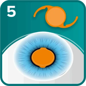 RLE step 5 - the IOL is inserted and positioned within the lens capsule