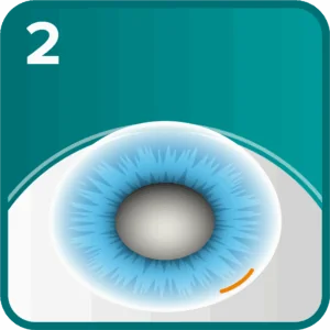 Cataract step 2 - small incision made at the base of the cornea for surgical access