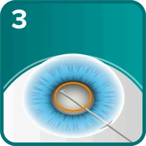 Cataract step 3 - the front of the lens capsule is removed