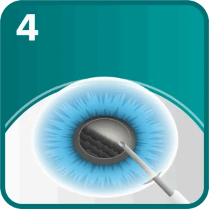 Cataract step 4 - the clouded lens is ultrasonically broken up and removed