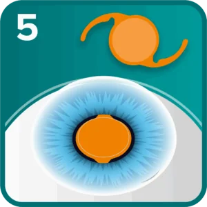 Cataract step 5 - the IOL is inserted and positioned within the lens capsule
